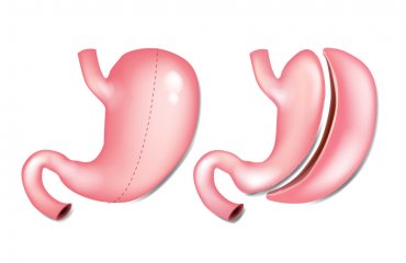 Gastric Sleeve Surgery