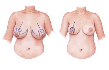 Breast Reduction