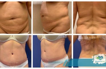 Abdominoplasty