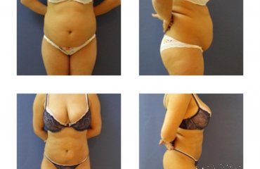 Abdominoplasty