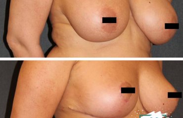 Breast Uplift