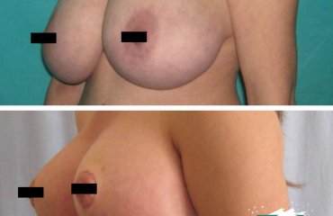 Breast Uplift