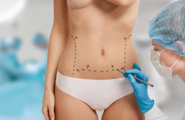 Tummy Tuck